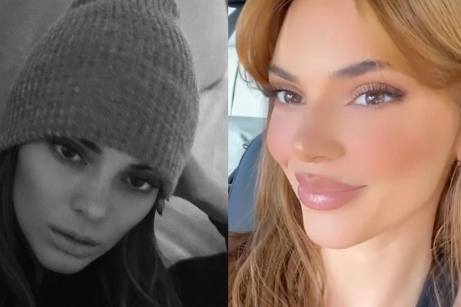 Έβαλε η Kendall Jenner fillers στα χείλη;