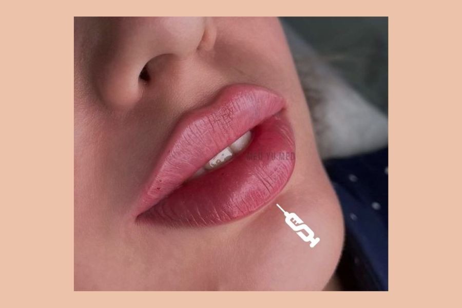 Τι ακριβώς συμβαίνει στο δέρμα σου όταν βάζεις lip fillers