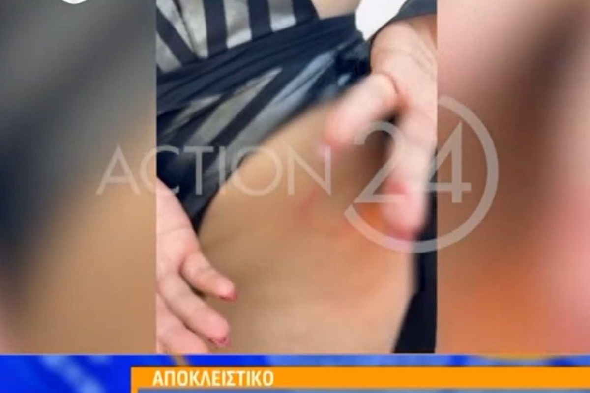 Ποια τραγουδίστρια δέχθηκε επίθεση από χελώνα καρέτα‑καρέτα και τι αποκάλυψε για τον τραυματισμό της